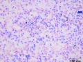 Mast cell tumor (Wright