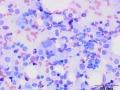 Mast cell tumor (Wright