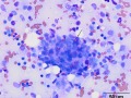 Mast cell tumor (Wright