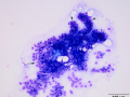 Carcinoma (intestine/pancreas)