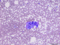 Carcinoma (lymph node)