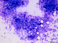 Carcinoma (intestine/pancreas)