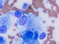 Hemangiosarcoma