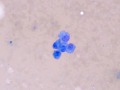 Hemangiosarcoma
