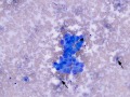 Hemangiosarcoma