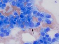 Hemangiosarcoma