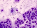 Mast cell tumor (Wright