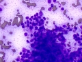 Mast cell tumor (Wright