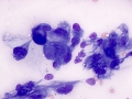 Carcinoma (stomach)