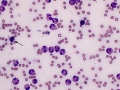 Eosinophils (stomach)