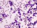 Eosinophils (stomach)