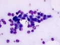 Eosinophils (LN)