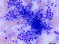 Salivary adenocarcinoma