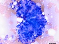 Salivary adenocarcinoma