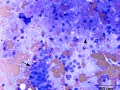 Salivary adenocarcinoma