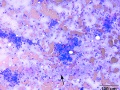 Salivary adenocarcinoma