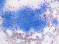 Apocrine anal sac adenocarcinoma (AGASACA)