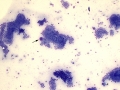 Apocrine anal sac adenocarcinoma