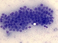 Apocrine anal sac adenocarcinoma