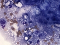Granulomatous inflammation (meibomian gland)