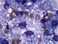 Granulomatous inflammation (meibomian gland)