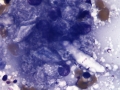 Granulomatous inflammation (meibomian gland)