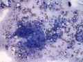 Granulomatous inflammation (meibomian gland)