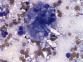 Granulomatous inflammation (meibomian gland)