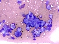 Complex mammary adenoma (dog)