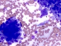 Complex mammary adenoma (dog)
