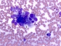 Complex mammary adenoma (dog)