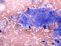 Prostate (squamous metaplasia)