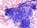 Prostate (squamous metaplasia)