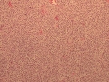 Thyroid C cell tumor (dog)