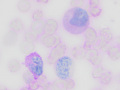 Eosinophilic leukemia (PAS)