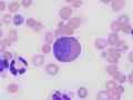 Eosinophilic leukemia (Wright's)