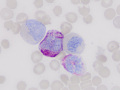 Eosinophilic leukemia (CAE)