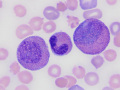 Eosinophilic leukemia (Wright's)