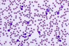 Leukemia