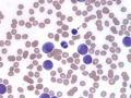 Acute myeloid leukemia (AML, dog)