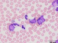 B cell leukemia (CD22+)