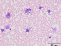 B cell leukemia (CD22+)