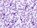 Chronic lymphocytic leukemia (CLL, dog, DQ)
