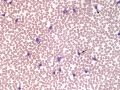 Leukemia of granular lymphocytes (GL-CLL)