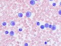 Post-transplantation leukemia 