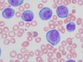 Post-transplantation leukemia 