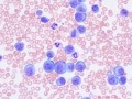 Post-transplantation leukemia 