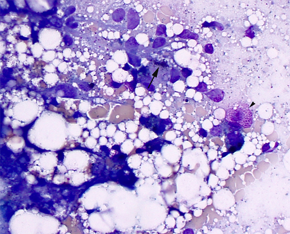 Suspect kupffer cell & mast cell