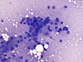 Hepatocellular carcinoma