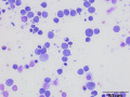Lymphoma of granular lymphocytes (cat, PTF)